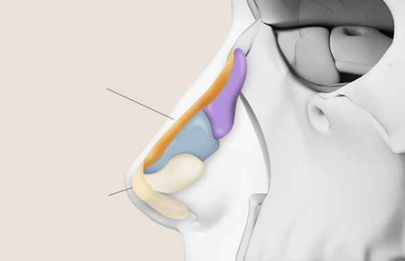 Nasal Tip (Autologous Rib Cartilage) + Nasal Bridge (Autologous Rib Cartilage)