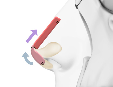 02. Nasal Tip Sculpting with Rib Cartilage