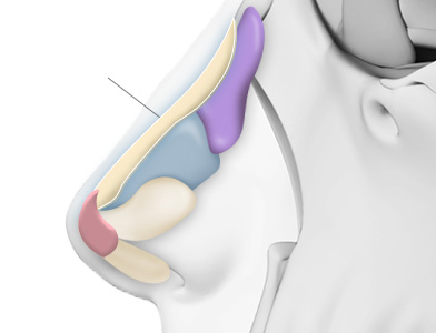 05. Autologous rib cartilage insertion