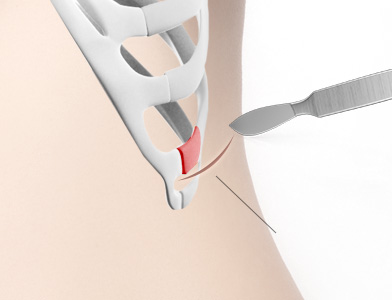 01. Harvesting Rib Cartilage