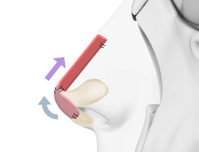 02. Nasal Tip Shaping with Cartilage Reinforcement