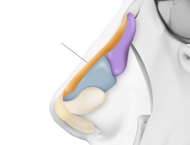 05. Inserting the Silicone