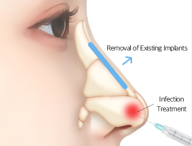 06. Nasal Septum Reconstruction Using Rib Cartilage
