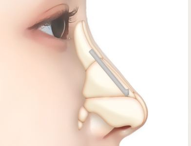 07. Removal of Existing Implants and Infection Treatment