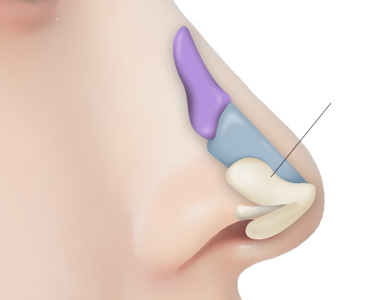 08. Insertion of Designed Rib Cartilage