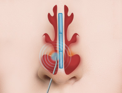 02. Mucosal Reduction Surgery