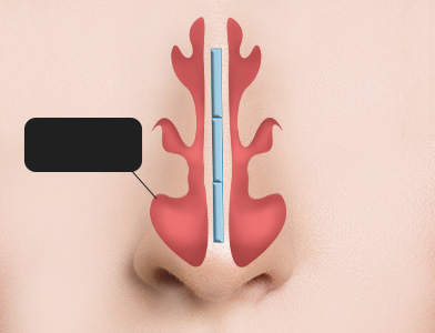 03. After Surgery