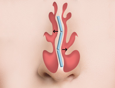 02. Repositioning of the Nasal Septum