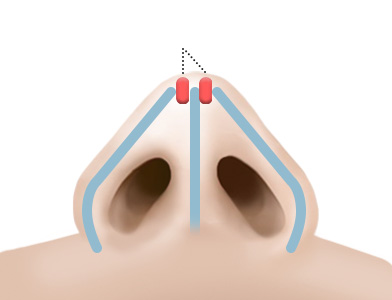 02. Cartilage Transplantation