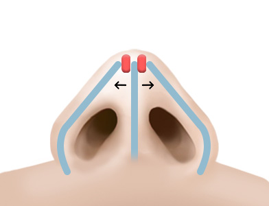 03. After Surgery
