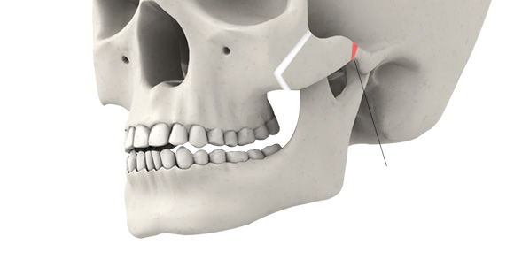 02. Zygomatic Arch Osteotomy
