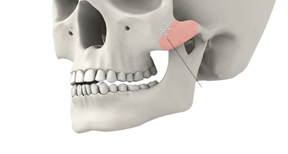04. Fixing the Moved and Reduced Cheekbone