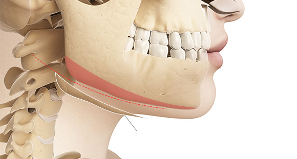 01. Long curve resection