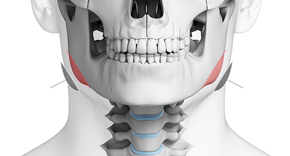 02. Cortical bone resection