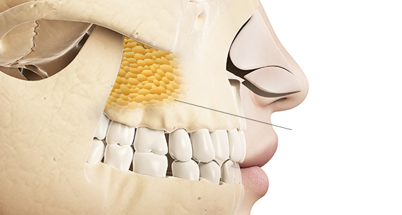 03. Buccal Fat Removal