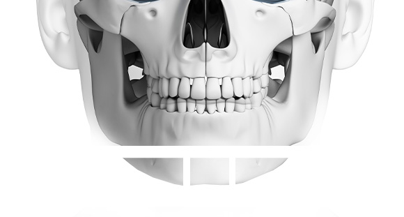 01. T Osteotomy