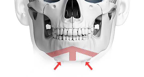02. Inverted V Osteotomy