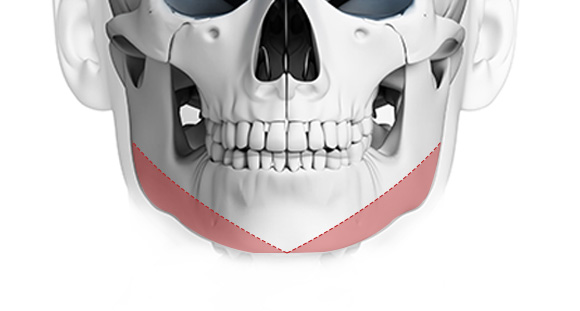 03. V Osteotomy
