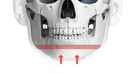 04. Sandwich Osteotomy
