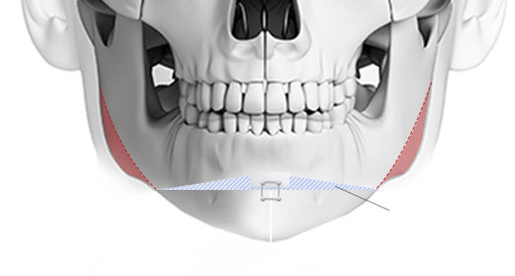05. Chin Lengthening
