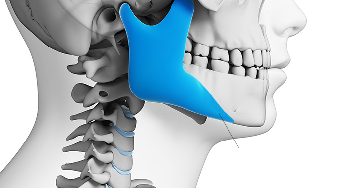 Customized implants