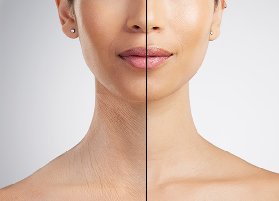 After Face and Neck Lift Surgery