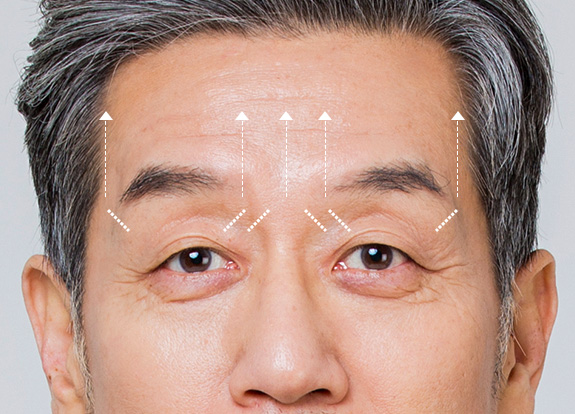 Brow Adjustment