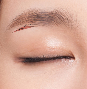 03. Suturing the Incision