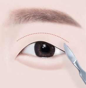 02. Skin Removal