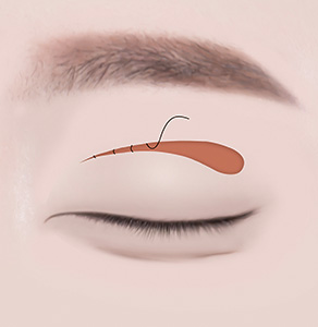 03. Suturing the Incision
