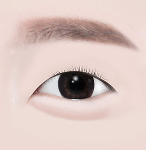 04. Completion of Surgery