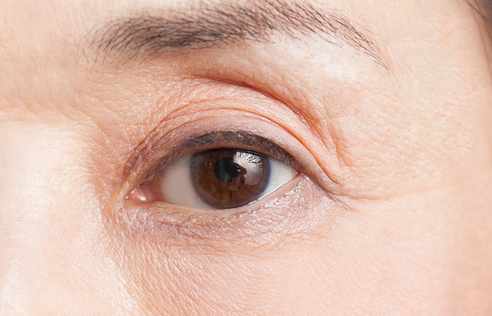 Upper Eyelid