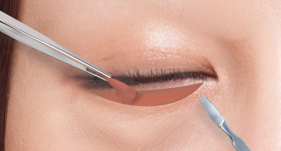 02. Removal of Sagging Skin