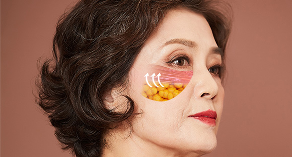 04. Midface Lift