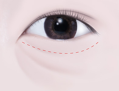 01. Incision