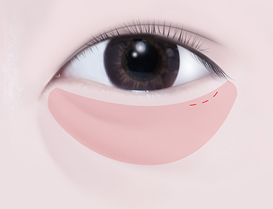02. Preservation of Orbital Septum