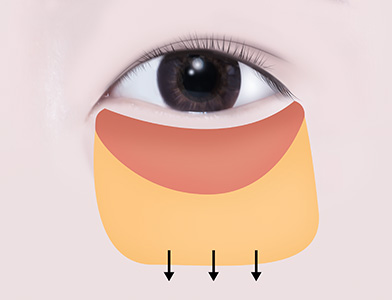 03. Accurate Dissection of Orbital and SOOF Fat