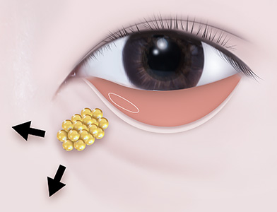 04. Repositioning of Lower Eyelid Fat