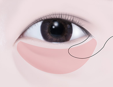 05. Formation of a Charming Lower Eyelid