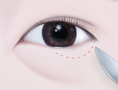 06. Skin Excision